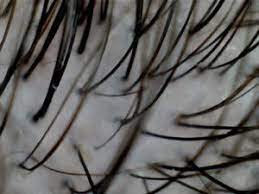 à queda. Isso acontece porque a inflamação gera alterações na sinalização químic