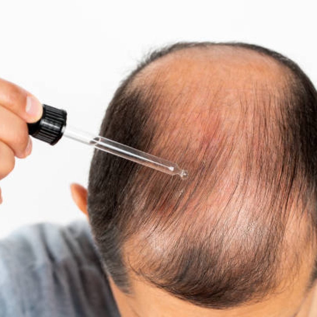 Young man hair treatment. Argan oil healthy massage.Close up of male person who applies a product to stop hair loss. Liquid cosmetic dropper therapy.