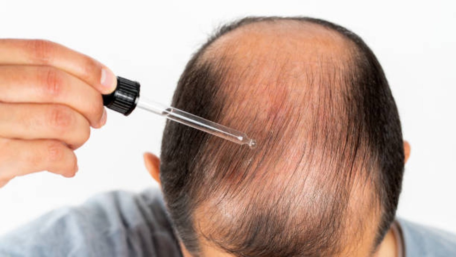 Young man hair treatment. Argan oil healthy massage.Close up of male person who applies a product to stop hair loss. Liquid cosmetic dropper therapy.