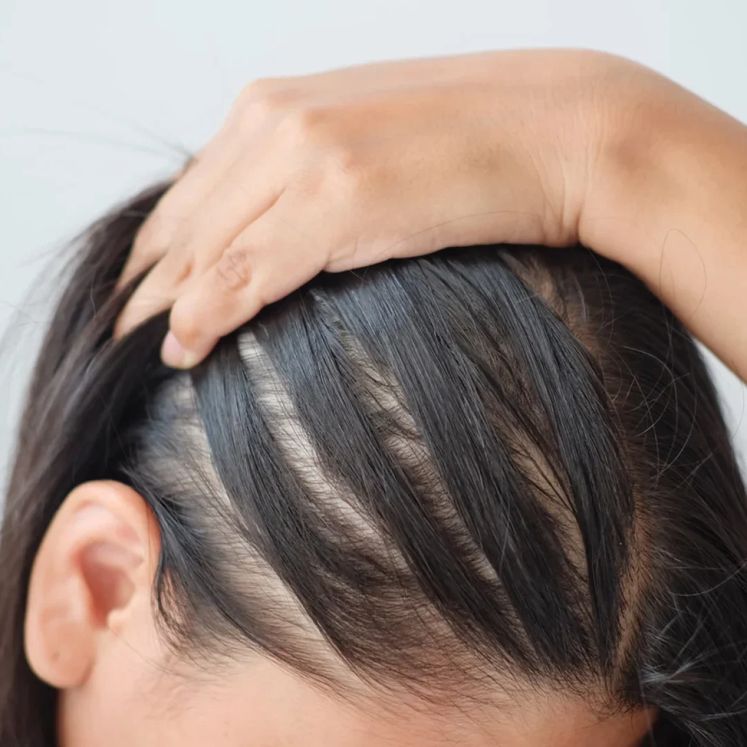 o-que-e-bom-para-queda-de-cabelo